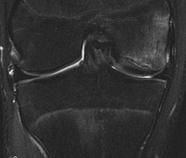 Knee OCD Case MRI 1